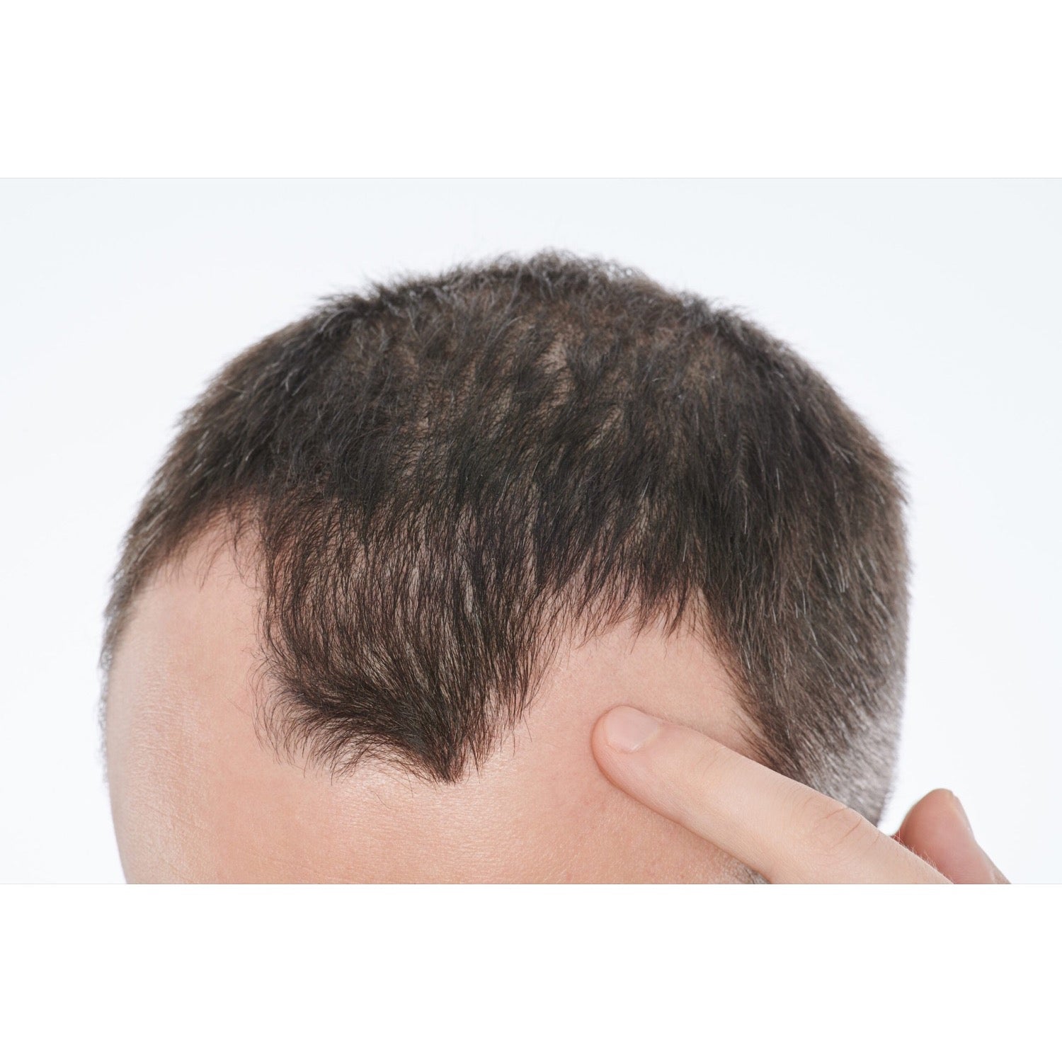 BCN SCALP - Solución Innovadora para la Alopecia