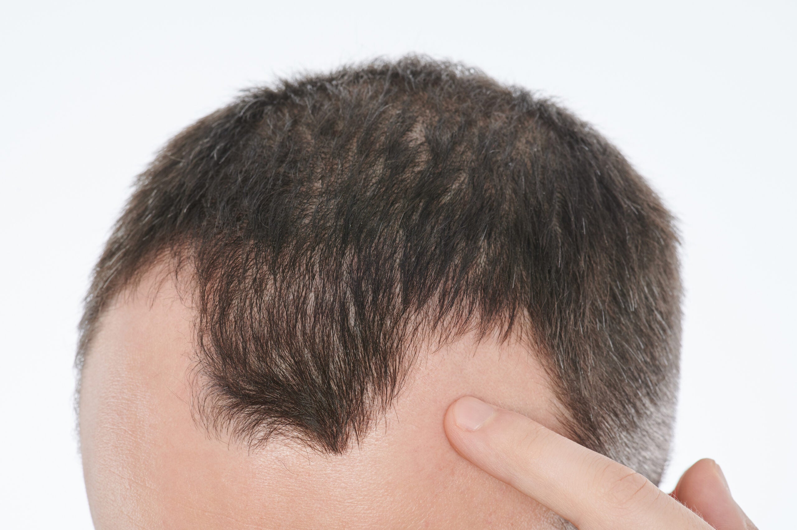 BCN SCALP - Solución Innovadora para la Alopecia