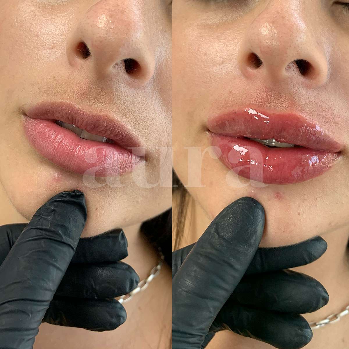 Perfilado y aumento de labios con Ácido Hialurónico