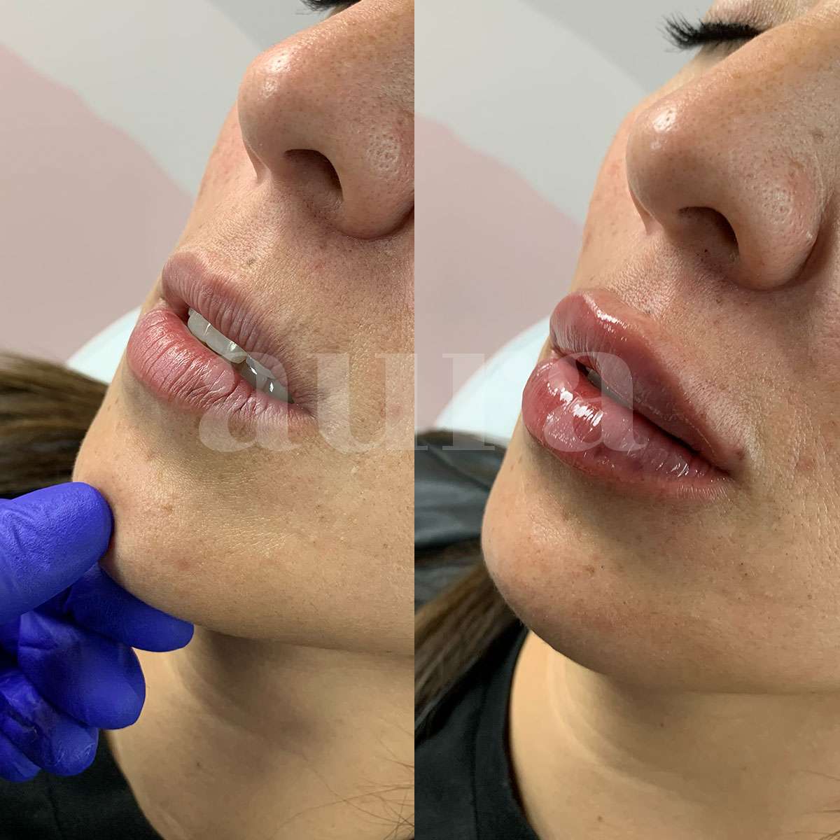 Perfilado y aumento de labios con Ácido Hialurónico