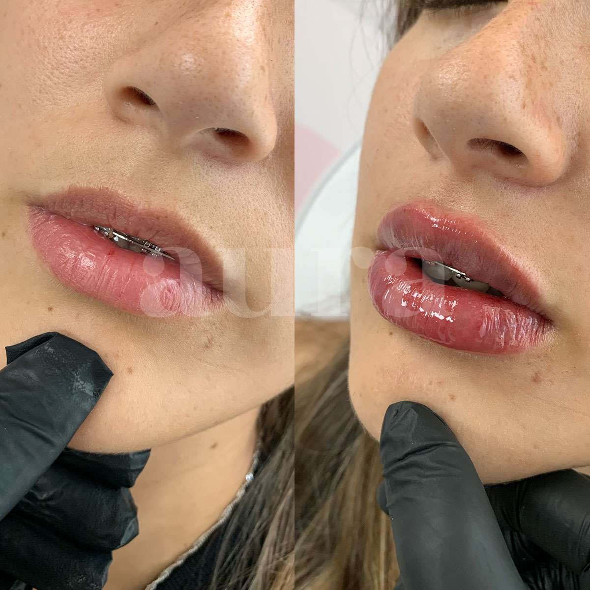 Perfilado y aumento de labios con Ácido Hialurónico