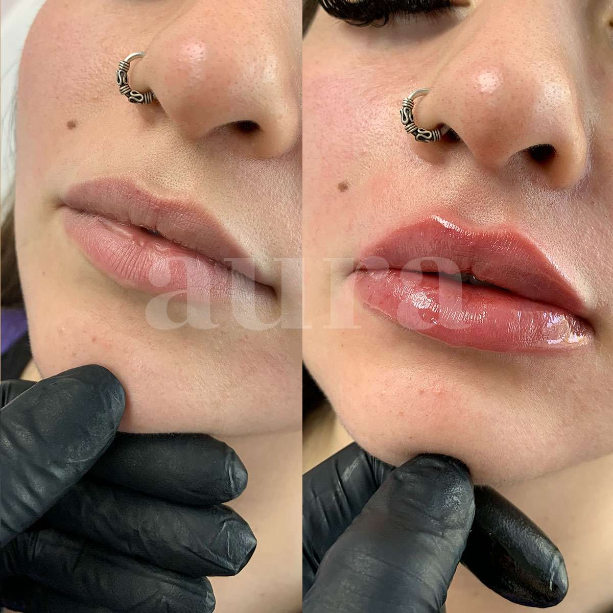 Perfilado y aumento de labios con Ácido Hialurónico